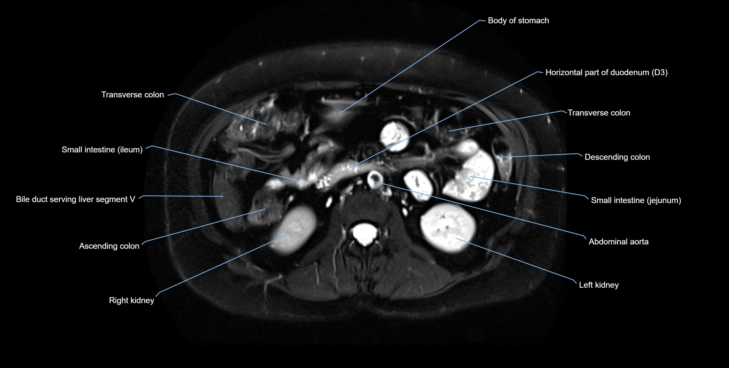 MRI MRCP axial cross sectional anatomy 3T radiology  image-img-10001-00032.webp